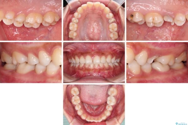 抜歯と言われた歯を残したい　部分矯正と外科処置を用いた補綴治療 治療前画像