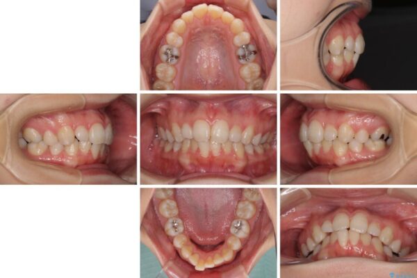 抜歯矯正の後戻り　インビザライン・ライトによる矯正治療 治療前画像