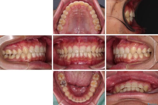 深い咬み合わせと隙間の空いた歯列をワイヤー矯正で改善 治療後画像