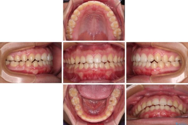 舌突出癖で隙間の空いてしまう歯列　舌トレーニングを行ったインビザライン矯正 治療途中画像