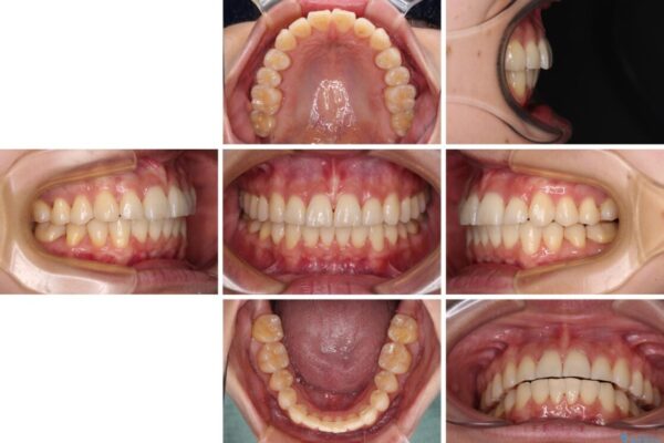 前にずれた咬み合わせをワイヤー装置でしっかりと改善 治療後画像