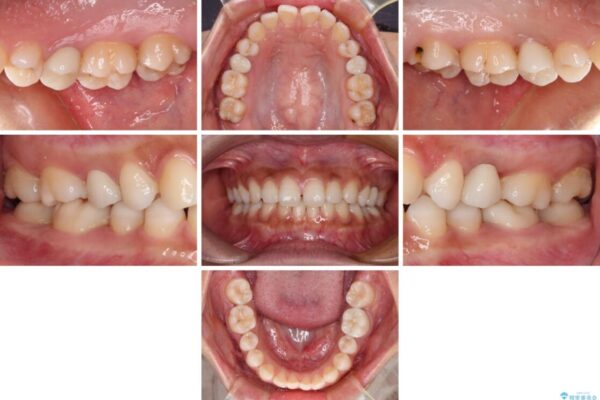 抜歯と言われた歯を残したい　部分矯正と外科処置を用いた補綴治療 治療後画像