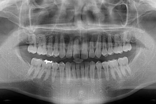 深い咬み合わせと隙間の空いた歯列をワイヤー矯正で改善 治療前画像