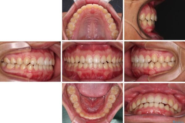 舌突出癖で隙間の空いてしまう歯列　舌トレーニングを行ったインビザライン矯正 治療後画像