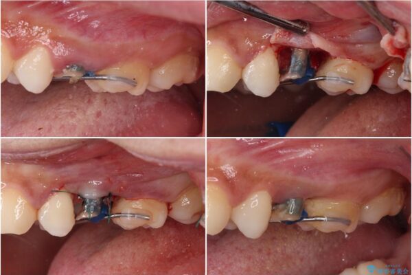 抜歯と言われた歯を残したい　部分矯正と外科処置を用いた補綴治療 治療途中画像