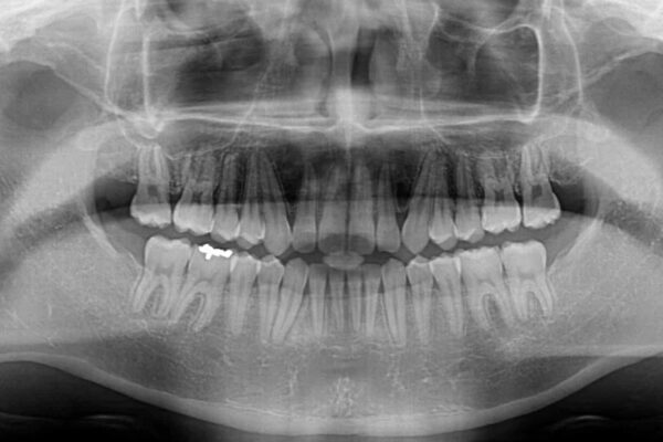 深い咬み合わせと隙間の空いた歯列をワイヤー矯正で改善 治療後画像