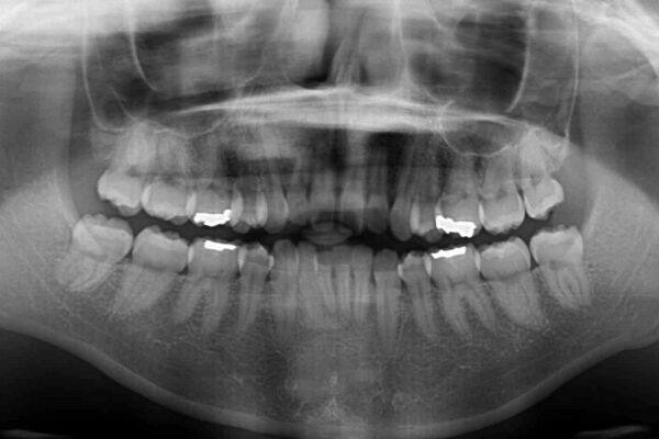 抜歯矯正の後戻り　インビザライン・ライトによる矯正治療 治療前画像