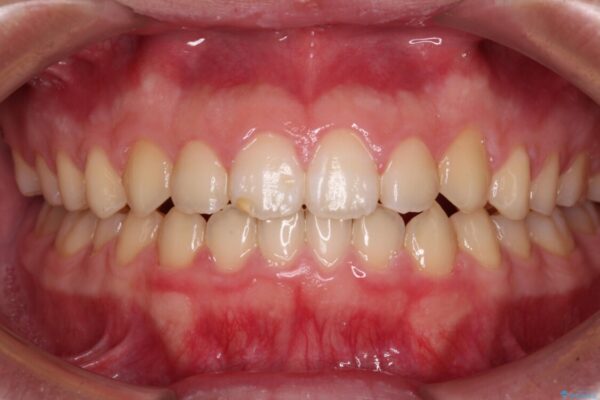 舌突出癖で隙間の空いてしまう歯列　舌トレーニングを行ったインビザライン矯正 アフター
