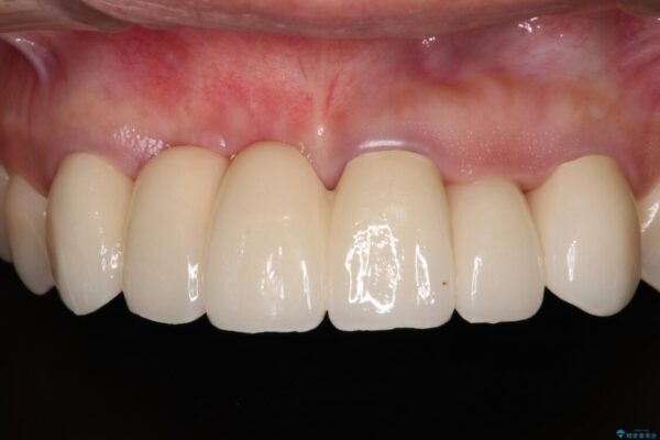 長く見える歯を治したい　歯肉移植による歯肉増大術 アフター