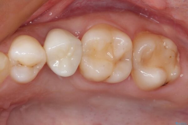 抜歯と言われた歯を残したい　部分矯正と外科処置を用いた補綴治療 アフター