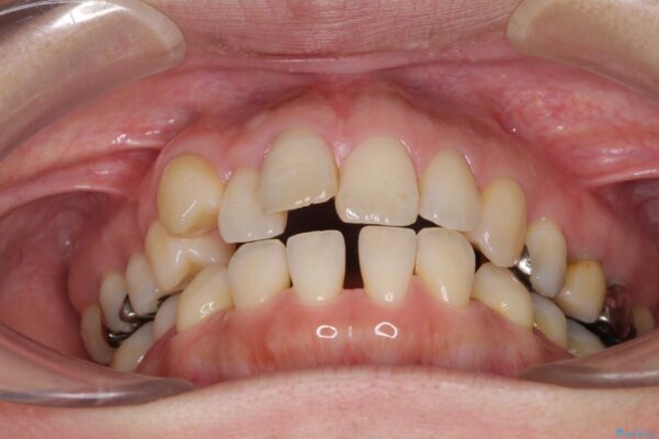閉じにくい口元と欠損歯列　ワイヤー装置の抜歯矯正 ビフォー