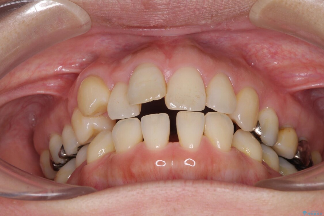 閉じにくい口元と欠損歯列　ワイヤー装置の抜歯矯正 治療前