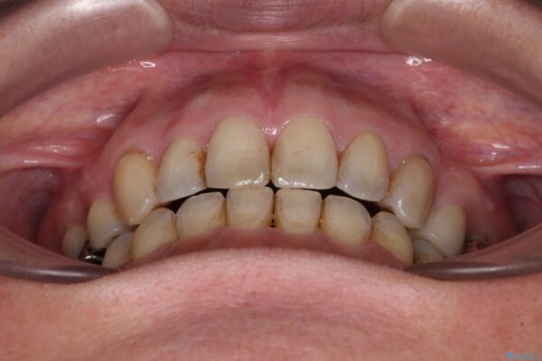 閉じにくい口元と欠損歯列　ワイヤー装置の抜歯矯正 アフター