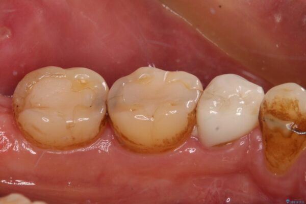 痛みの続く大きな虫歯の奥歯　オールセラミッククラウンでの補綴治療 治療前画像