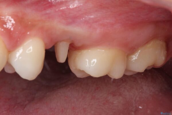 抜歯と言われた歯を残したい　部分矯正と外科処置を用いた補綴治療 治療途中画像