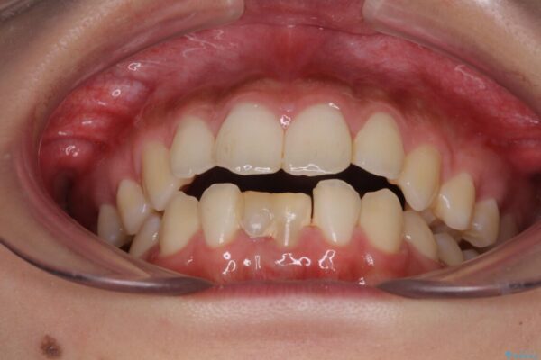 乳歯残存と欠損の前歯　矯正治療とオールセラミックブリッジ治療 ビフォー