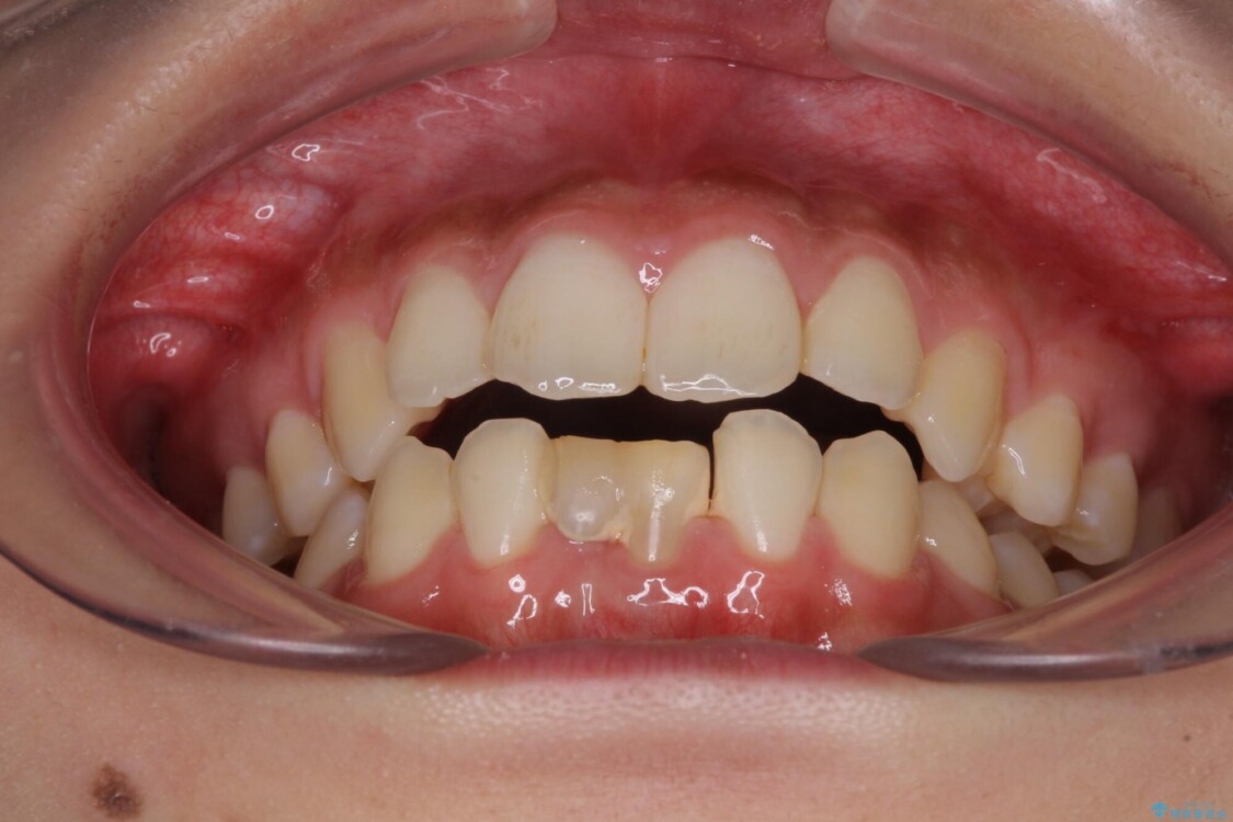 乳歯残存と欠損の前歯　矯正治療とオールセラミックブリッジ治療 治療前