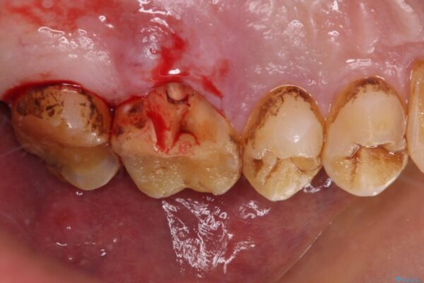 食事で割れてしまった奥歯　外科処置を用いた補綴治療 治療途中画像