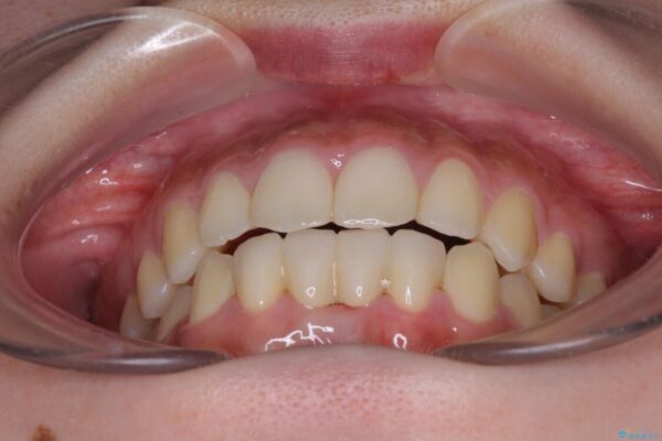 乳歯残存と欠損の前歯　矯正治療とオールセラミックブリッジ治療 アフター