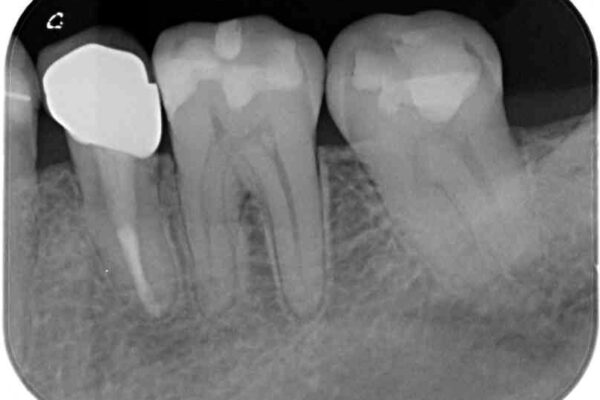 痛みの続く大きな虫歯の奥歯　オールセラミッククラウンでの補綴治療 治療前画像