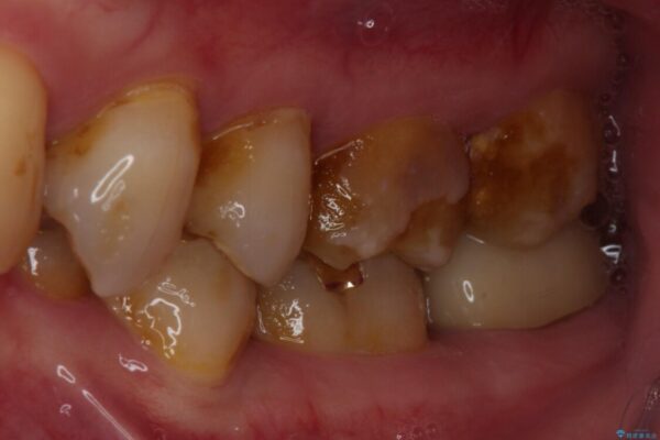 食事で割れてしまった奥歯　外科処置を用いた補綴治療 治療前画像