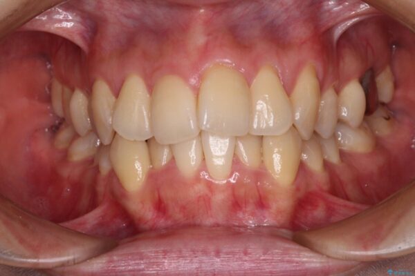 【モニター】急速拡大装置　狭い歯列を拡大してワイヤー装置で短期間治療 治療前画像