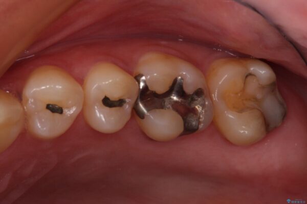 何度も外れてしまう銀歯　ゴールドインレーによる虫歯治療 ビフォー