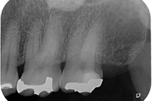 何度も外れてしまう銀歯　ゴールドインレーによる虫歯治療 治療後画像