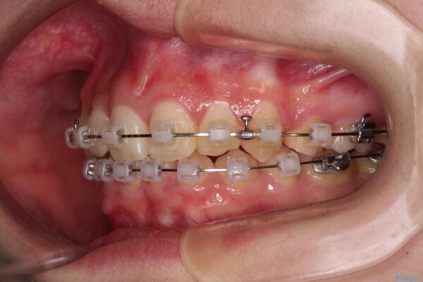 【モニター】下顎前歯の2本欠損　上顎のみの抜歯でバランスを取ったワイヤー矯正 治療途中画像