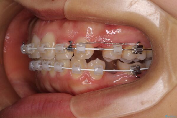 【モニター】閉じにくい口元　ワイヤー装置での抜歯矯正 治療途中画像