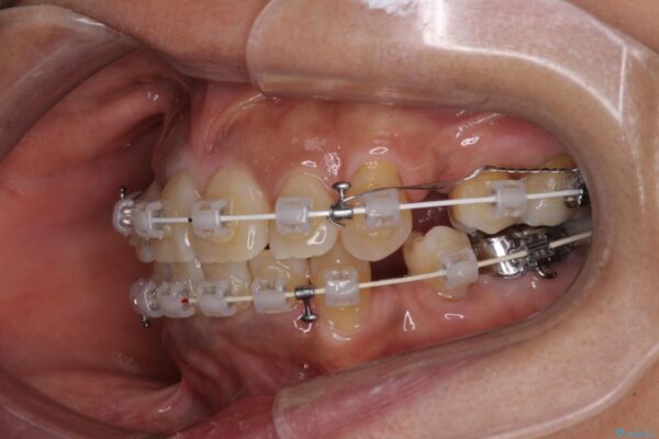 クロスバイトの前歯を治したい　ワイヤー装置でも抜歯矯正 治療途中画像