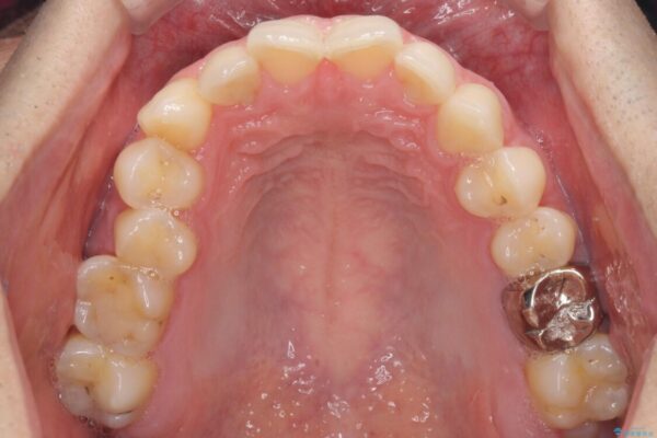 ディープバイトと叢生　インビザラインによる矯正治療 治療前画像