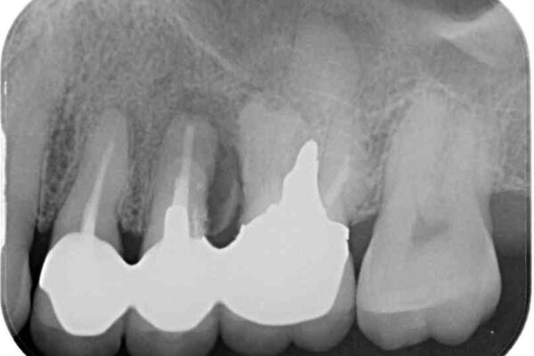 ものが挟まって痛む　割れてしまった歯のオールセラミックブリッジ治療 治療前画像