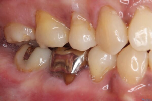 奥歯の銀歯をゴールドに 治療前画像