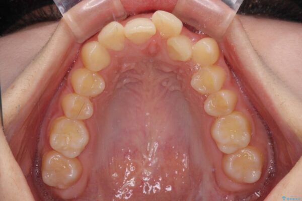 【モニター】下顎前歯の2本欠損　上顎のみの抜歯でバランスを取ったワイヤー矯正 治療前画像