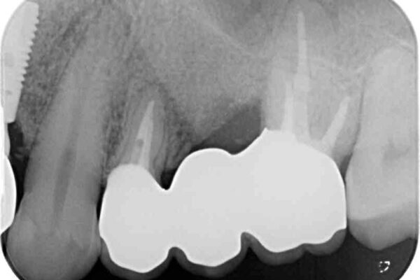ものが挟まって痛む　割れてしまった歯のオールセラミックブリッジ治療 治療後画像