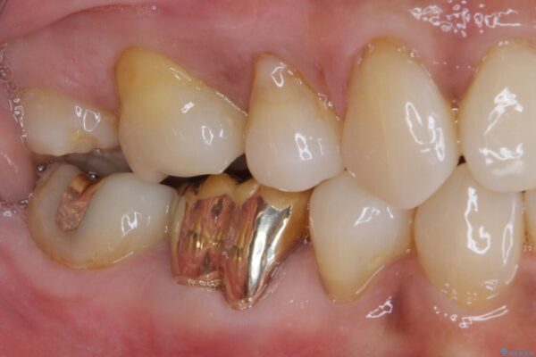 奥歯の銀歯をゴールドに 治療後画像
