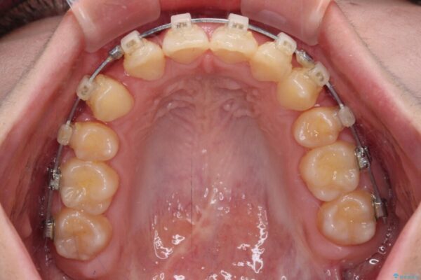 【モニター】下顎前歯の2本欠損　上顎のみの抜歯でバランスを取ったワイヤー矯正 治療途中画像