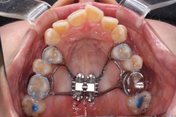 【モニター】急速拡大装置　狭い歯列を拡大してワイヤー装置で短期間治療 治療途中画像