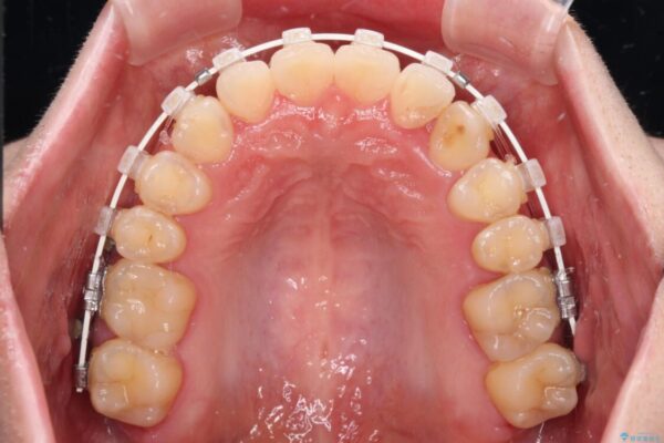 【モニター】1本欠損した下顎前歯と上顎の八重歯　ワイヤー装置で楽して矯正治療 治療途中画像