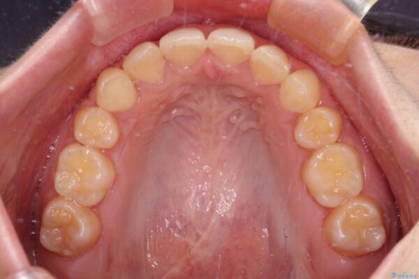 【モニター】下顎前歯の2本欠損　上顎のみの抜歯でバランスを取ったワイヤー矯正 治療後画像