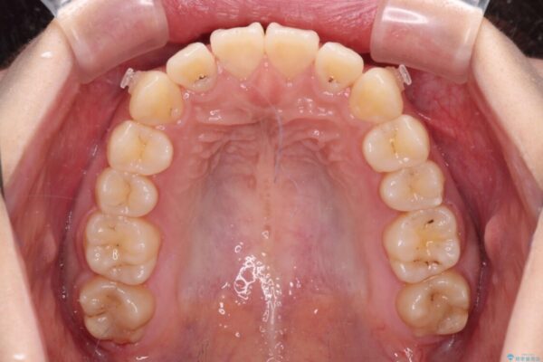 【モニター】捻れた前歯をスッキリと　インビザライン矯正治療 治療途中画像