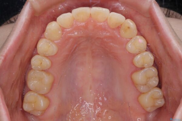 【モニター】1本欠損した下顎前歯と上顎の八重歯　ワイヤー装置で楽して矯正治療 治療後画像