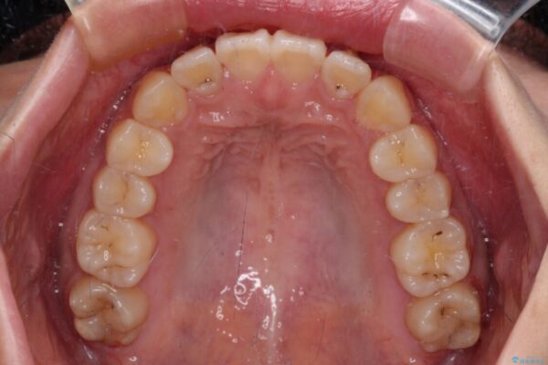 【モニター】捻れた前歯をスッキリと　インビザライン矯正治療 治療後画像