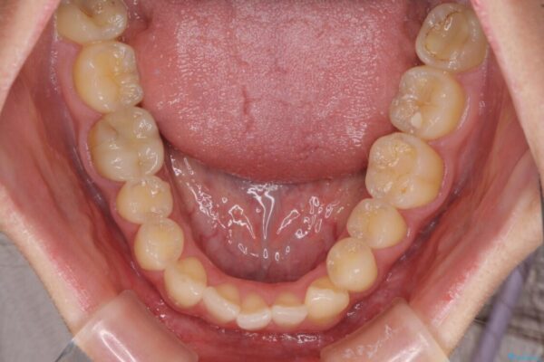 【モニター】1本欠損した下顎前歯と上顎の八重歯　ワイヤー装置で楽して矯正治療 治療前画像