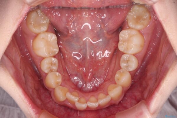【モニター】捻れた前歯をスッキリと　インビザライン矯正治療 治療前画像