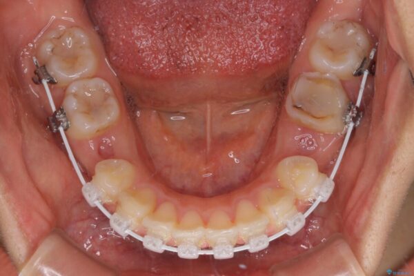 【モニター】閉じにくい口元　ワイヤー装置での抜歯矯正 治療途中画像