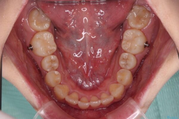 【モニター】捻れた前歯をスッキリと　インビザライン矯正治療 治療途中画像