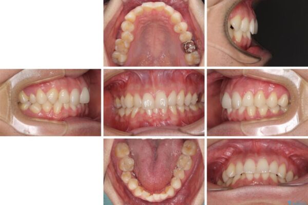 ディープバイトと叢生　インビザラインによる矯正治療 治療前画像