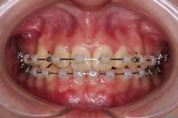【モニター】下顎前歯の2本欠損　上顎のみの抜歯でバランスを取ったワイヤー矯正 治療途中画像